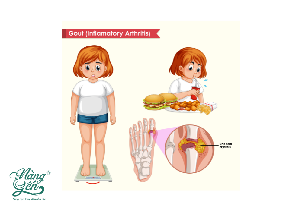 Bài viết: Bệnh Gout nên kiêng ăn gì và có dùng được tổ Yến không?